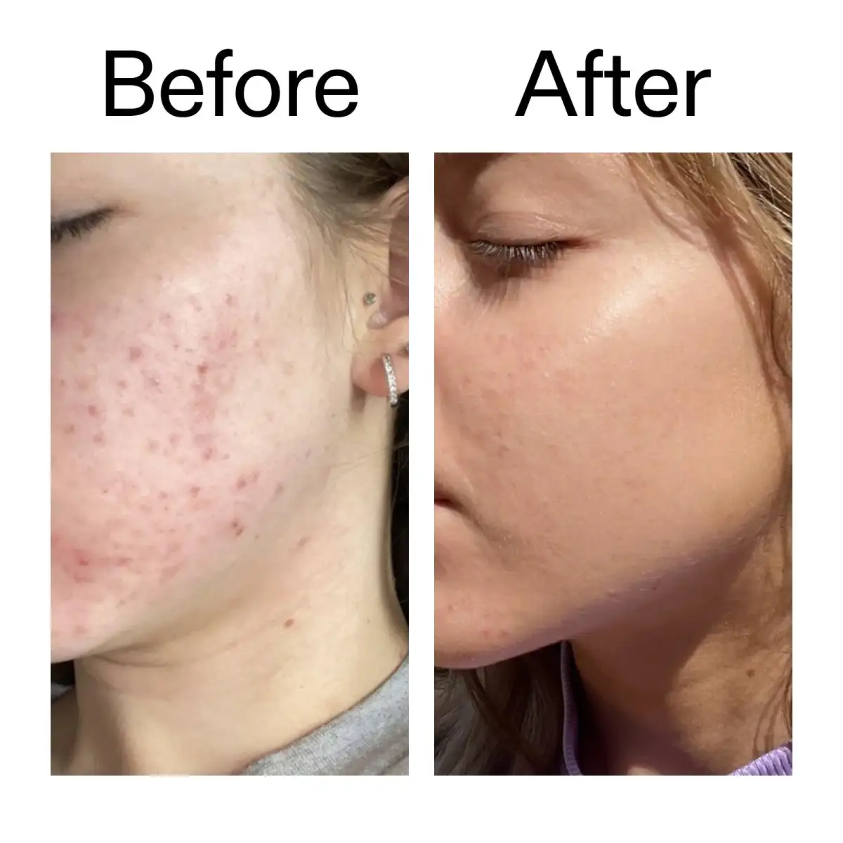 Kit For Oily Skin
